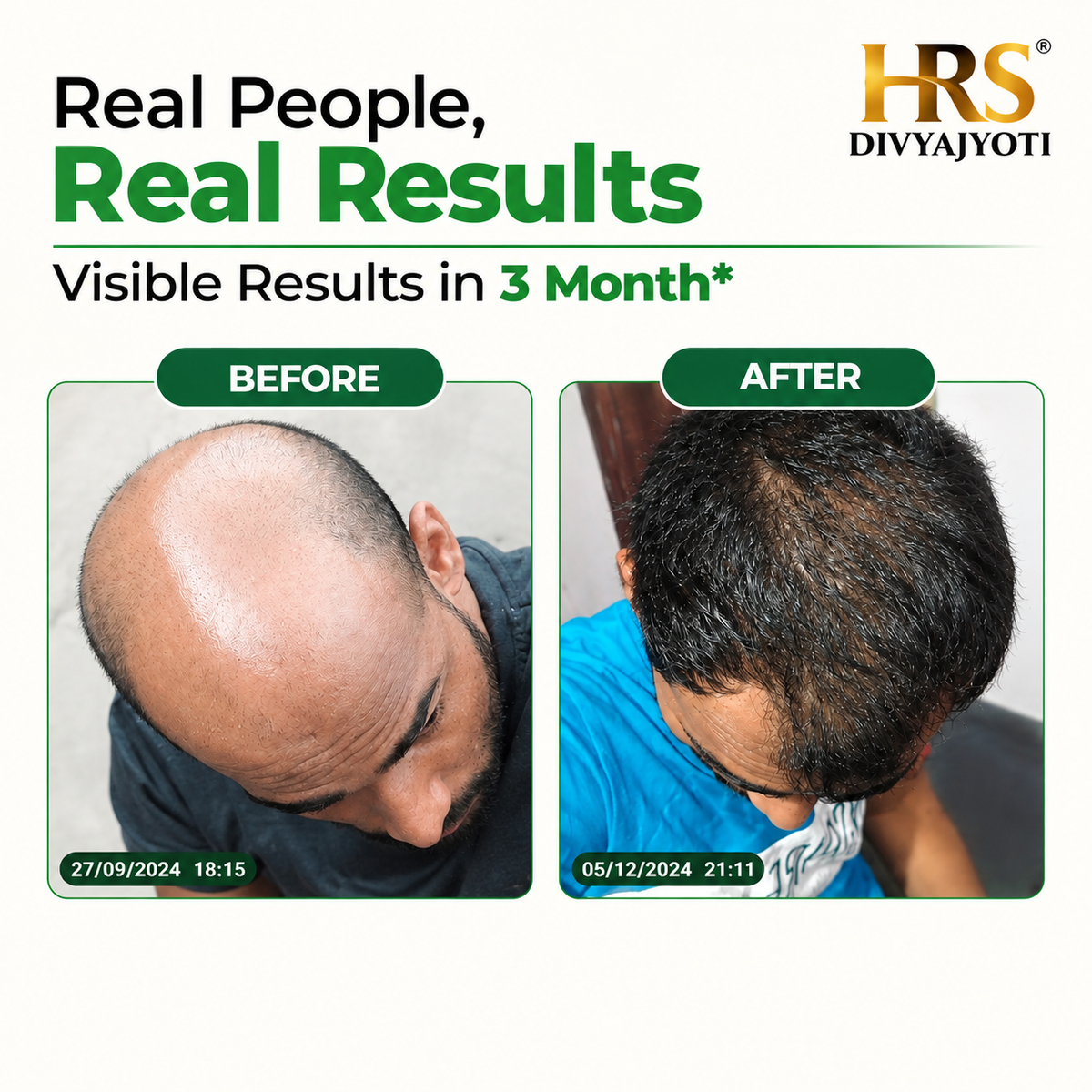 HRS Divyajyoti Hair Growth 2nd Month kit